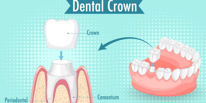 Top Benefits of Dental Crowns: Restore Function and Improve Your Smile