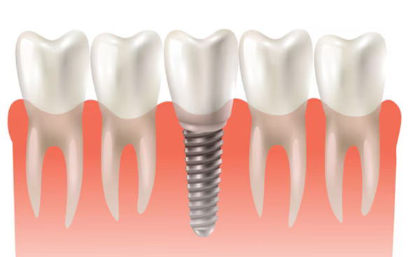 How Do Dental Implants Improve Oral Health and Function?