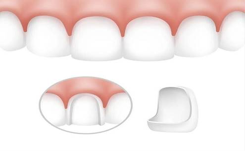 What Are Dental Veneers? How Do Dental Veneers Work?