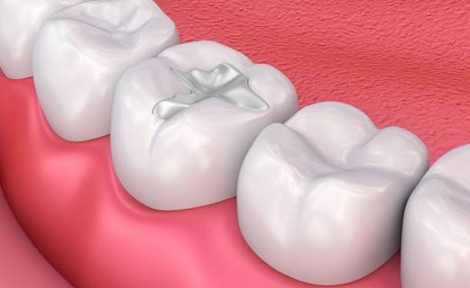 Sealants