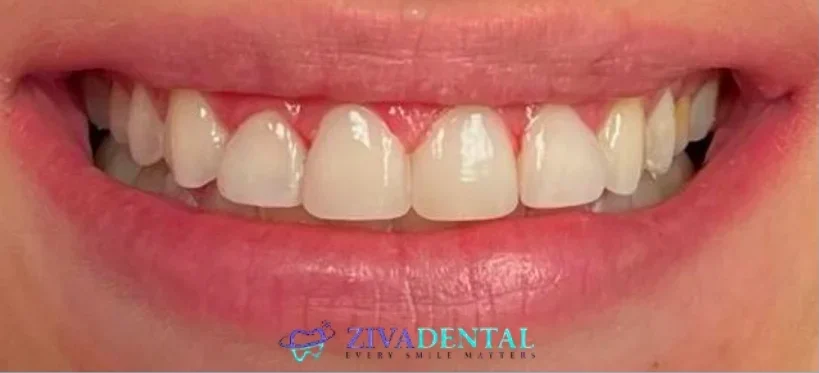 Resin Veneers After