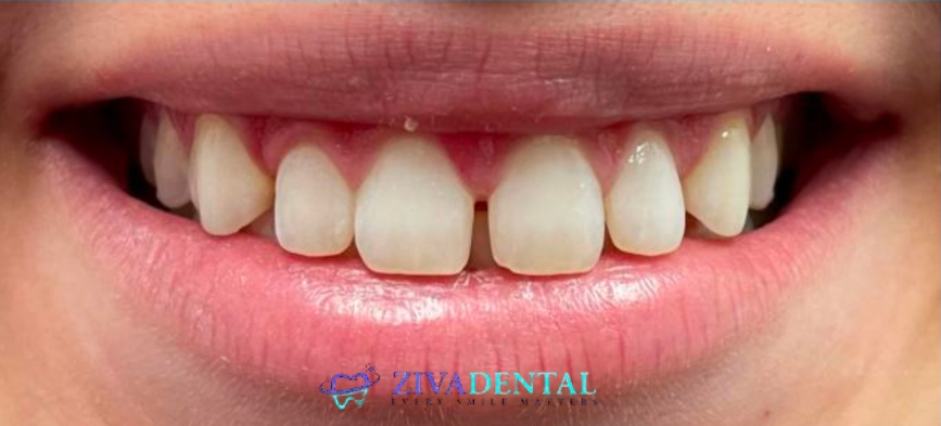 Resin Veneers Before